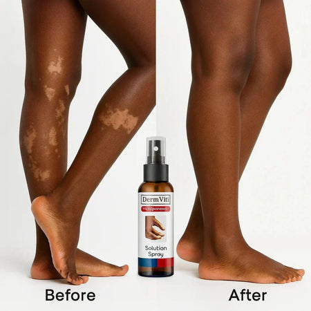 Spray Solution Réparatrice de la Peau Vitiligo